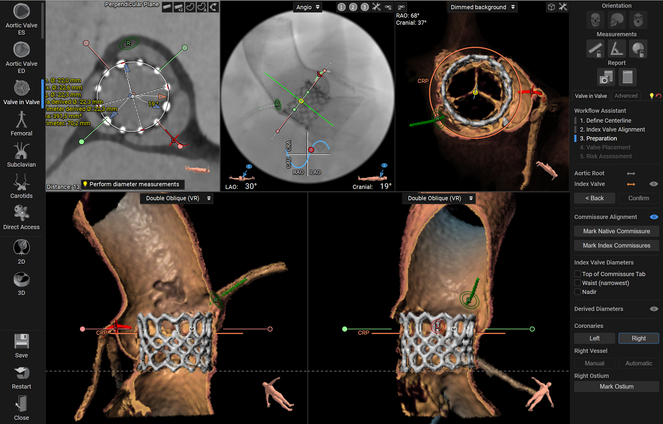 3mensio Valve in Valve workflow