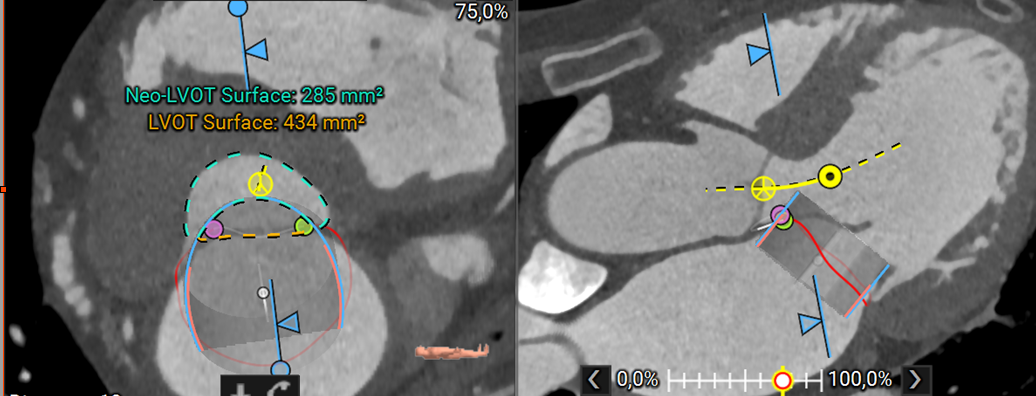 neo-lvot mitral.png