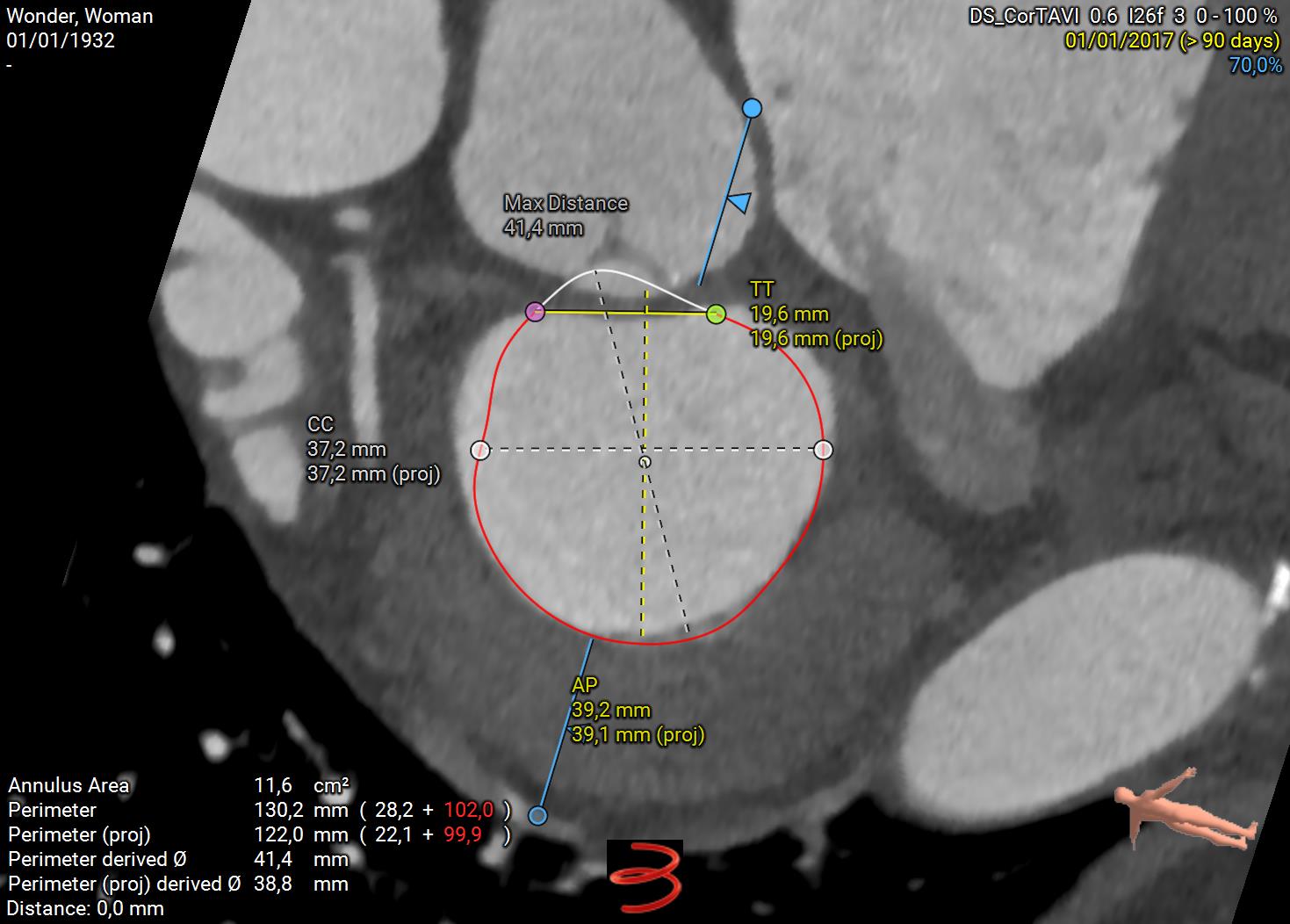 mitral-annulus-3mensio.jpg