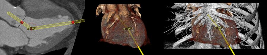 transapical.jpg