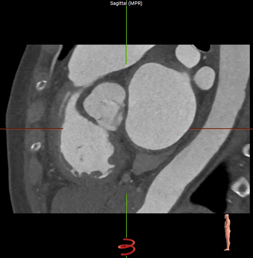 Sagittal-CT-Heart.jpg