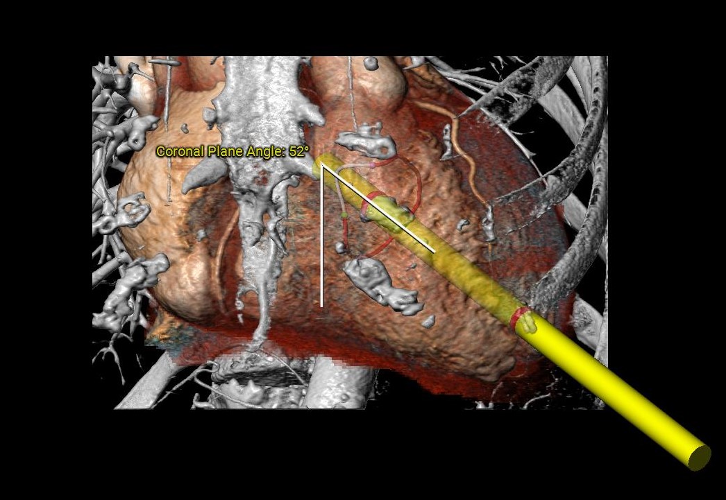 Transapical-approach.jpg