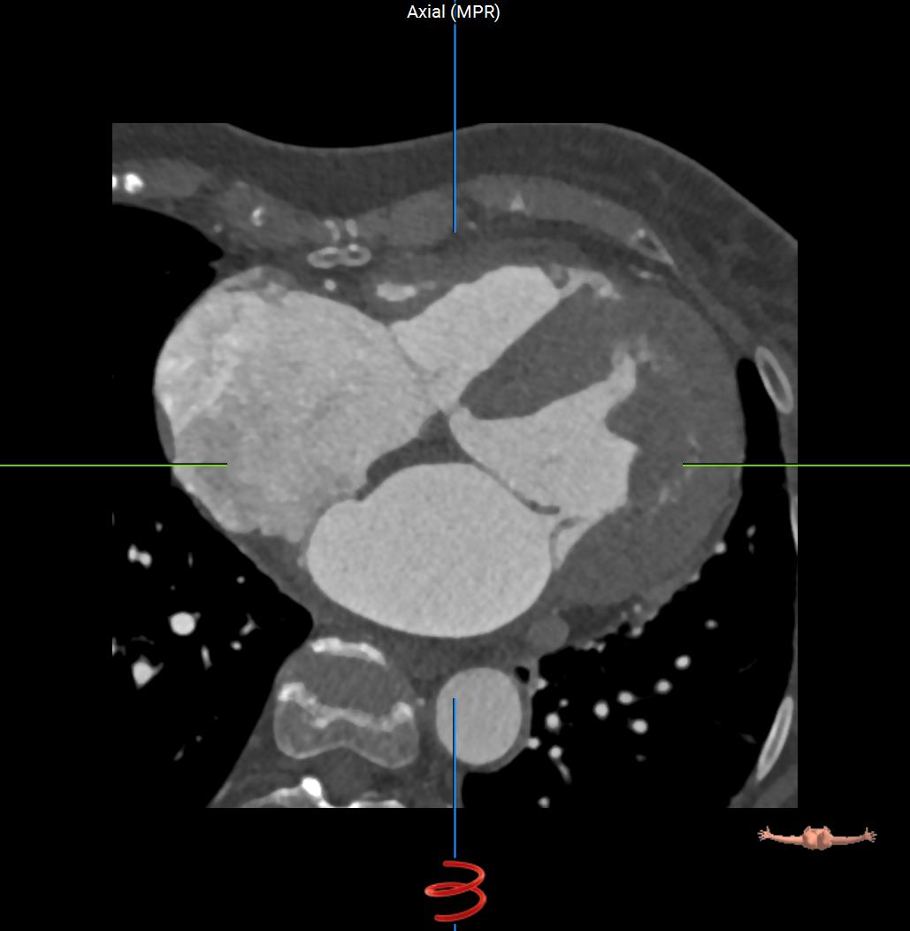 Axial-CT-Heart.jpg