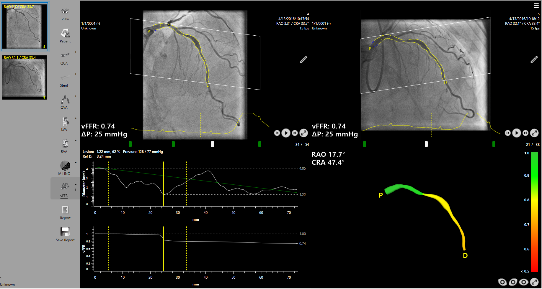 vFFR FAST I study published! :: Pie medical imaging