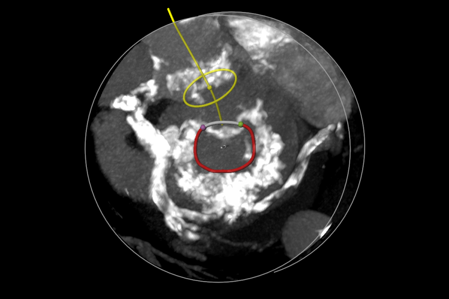 Mitral MAC