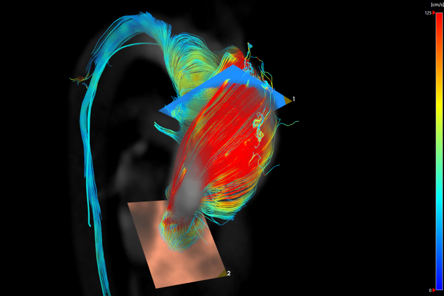 Bicuspid Aortic Valve - Streamlines