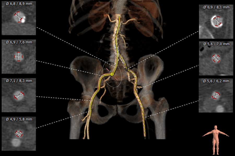 Femoral