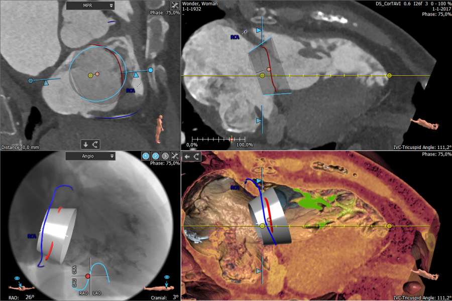 Tricuspid Workflow