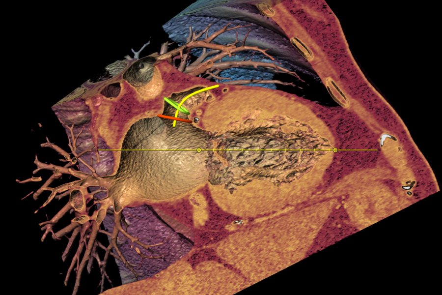 Intracardiac view