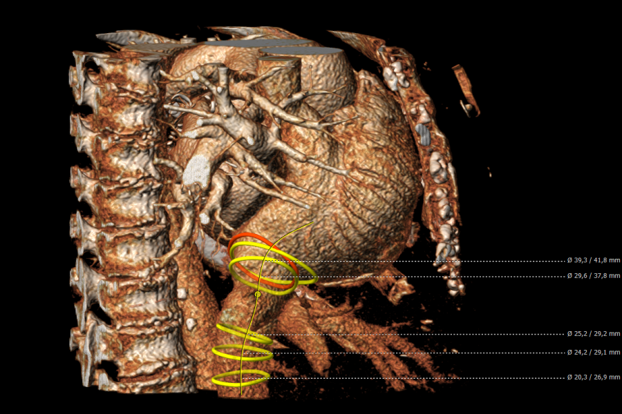 Inferior Vena Cava Assessment