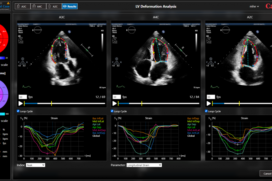 Myocardial strain analysis