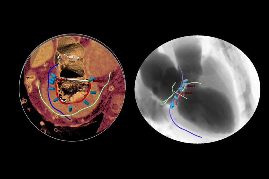 Mitral Cardioband