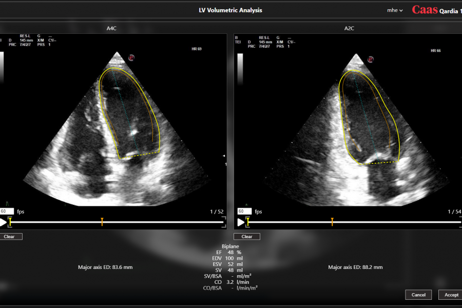 LV volumetric analysis