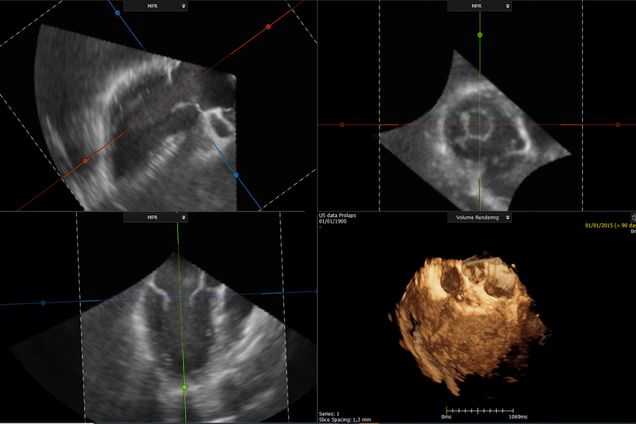 3D US Mitral