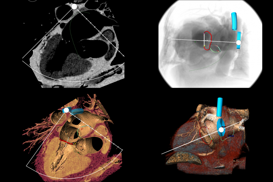 Mitral Tee overview