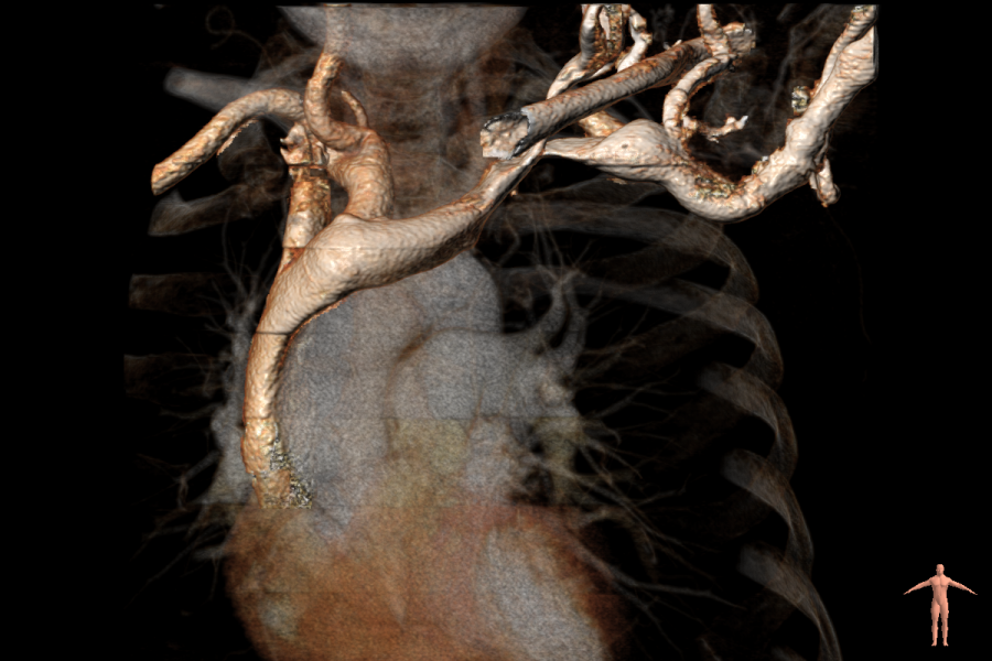 Superior Vena Cava Assessment