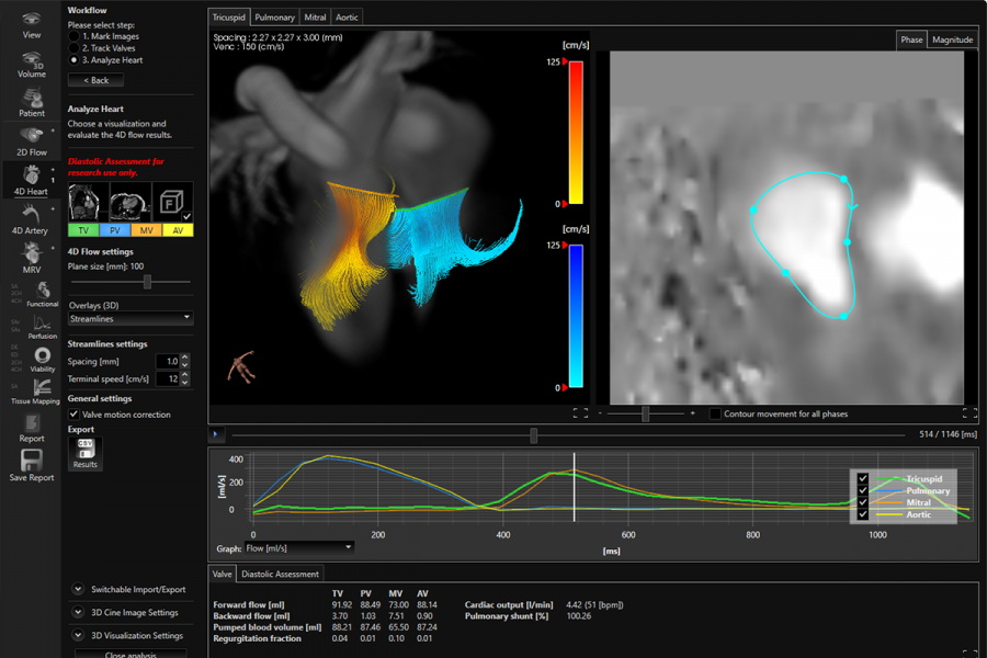 4D Heart - Streamlines over heart valves