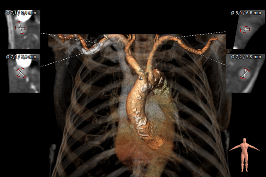 Subclavian