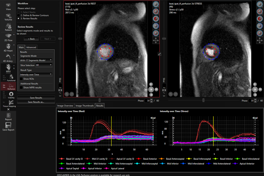 Perfusion Analysis