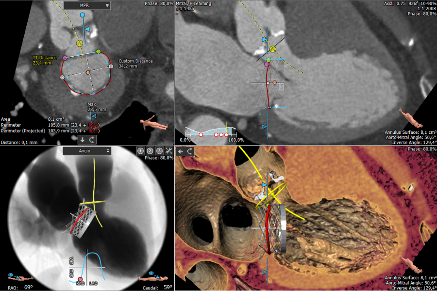 Mitral all views