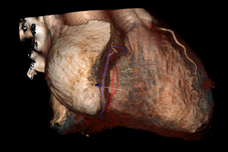 Relationship RCA and Tricuspid Annulus