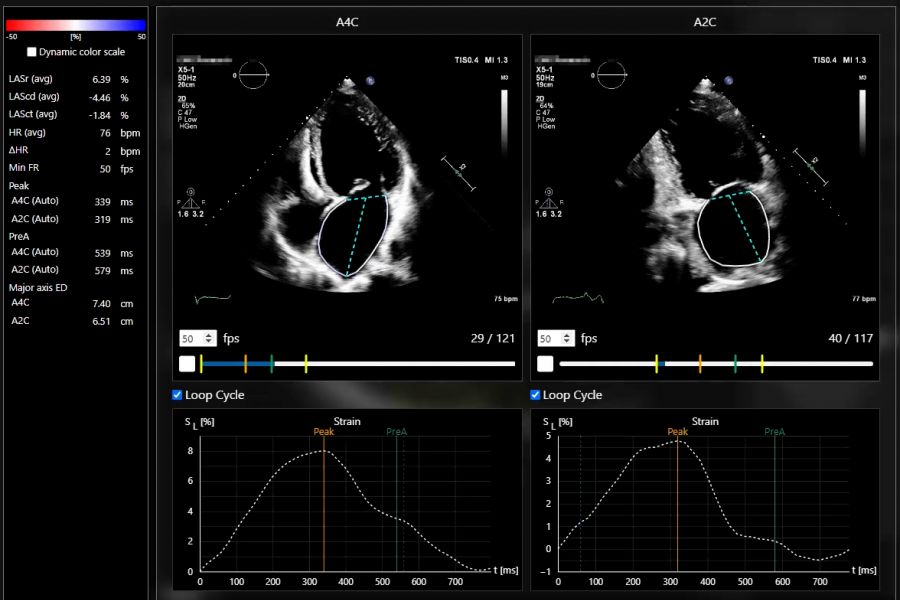 Left Atrial Strain