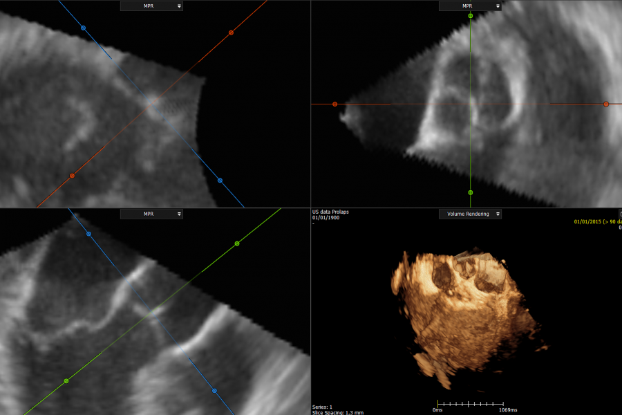 3D US Aortic