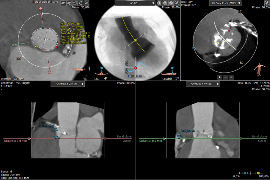 Aortic Valve Workflow