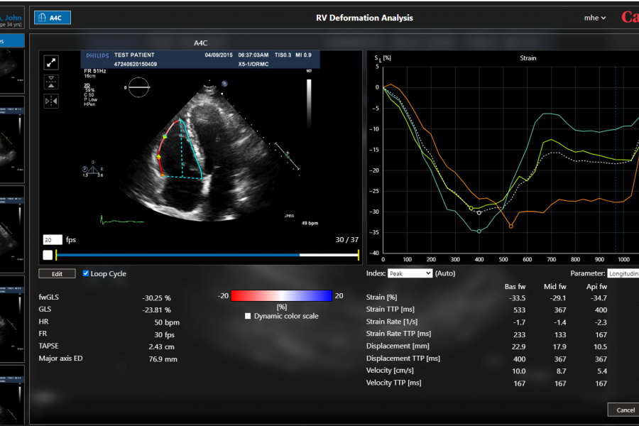 RV strain analysis