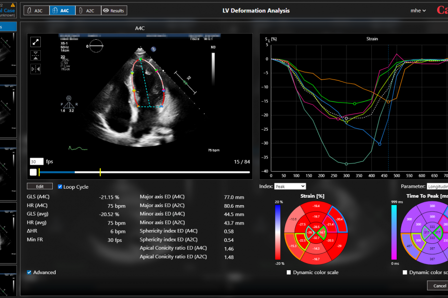 LV Strain Analysis