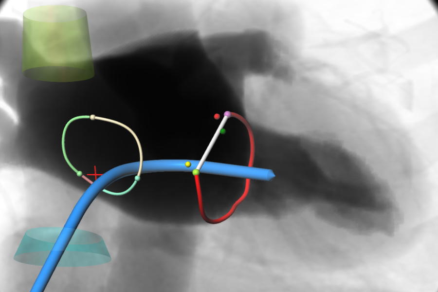 Mitral septal crossing