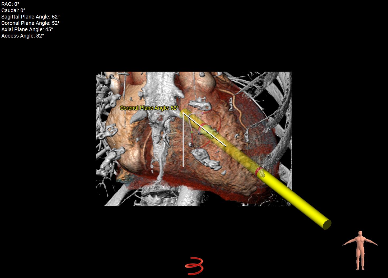 Transapical-approach.jpg