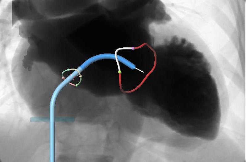 Transseptal-approach.jpg