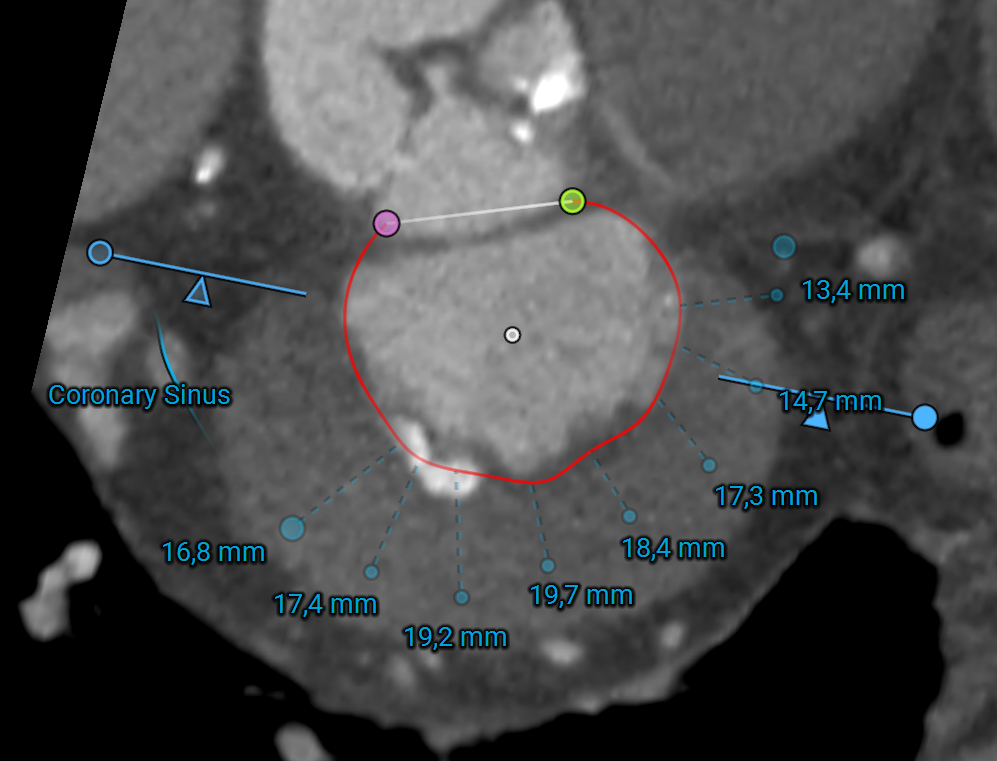coronary_sinus.png