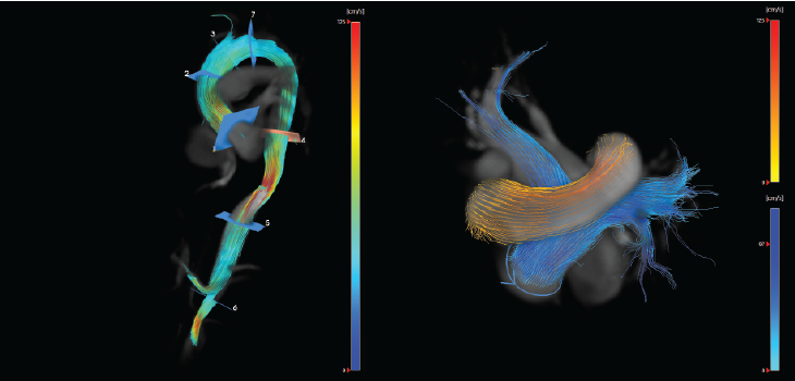 CAAS-MR-4D-flow_Streamlines.png